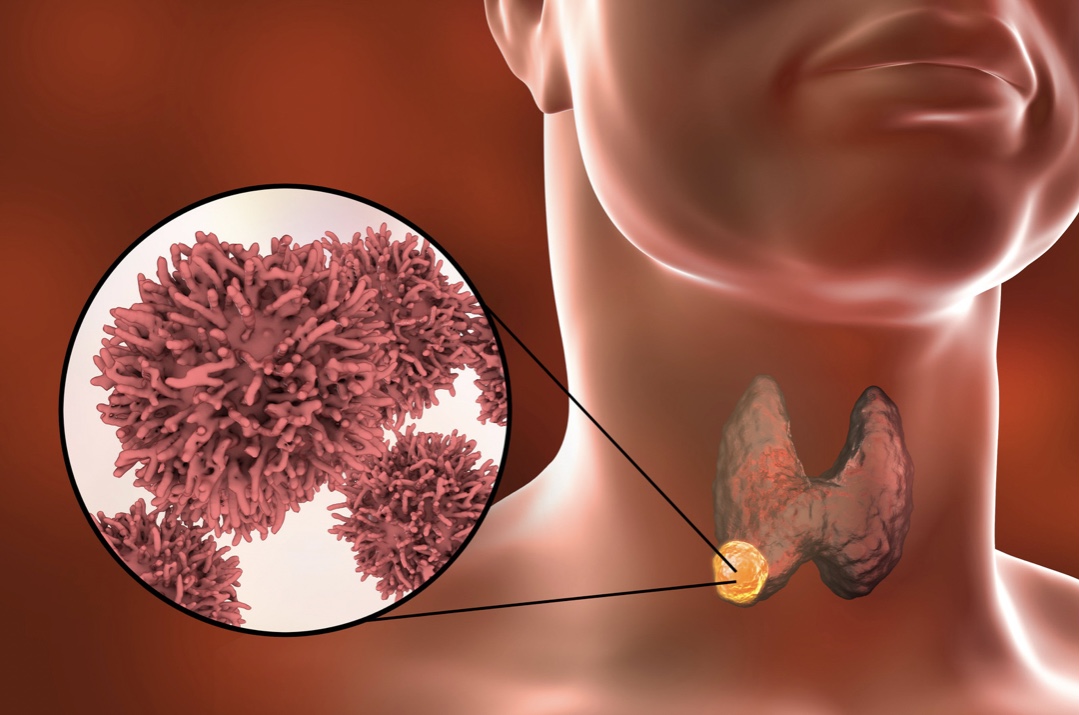 Throat Cancers: Causes and Treatments