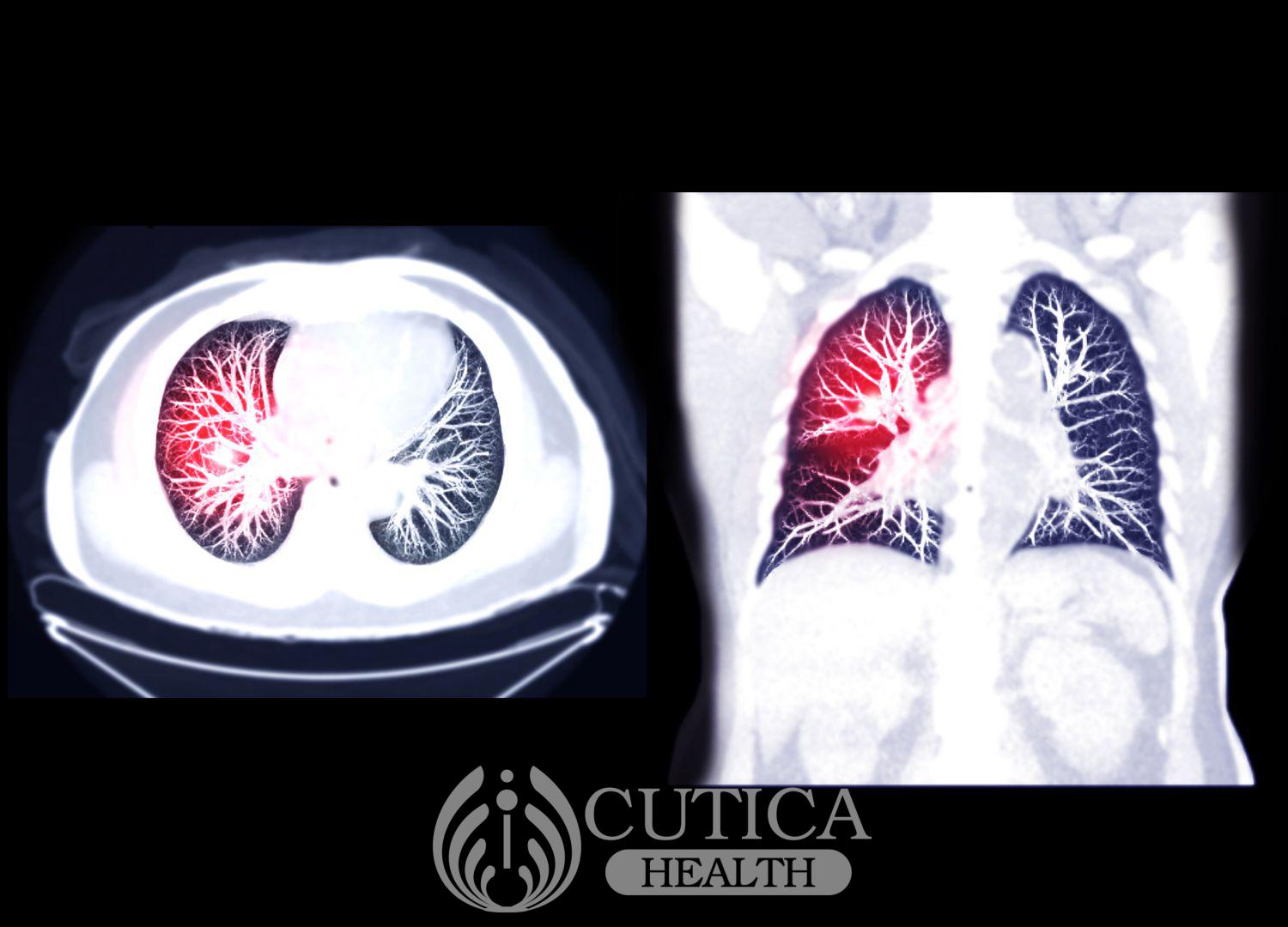 Pulmonary embolism