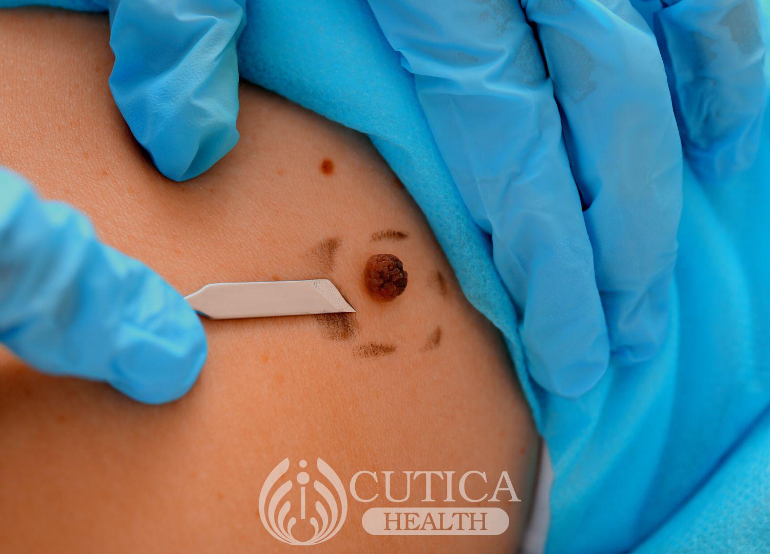 Skin Cancer