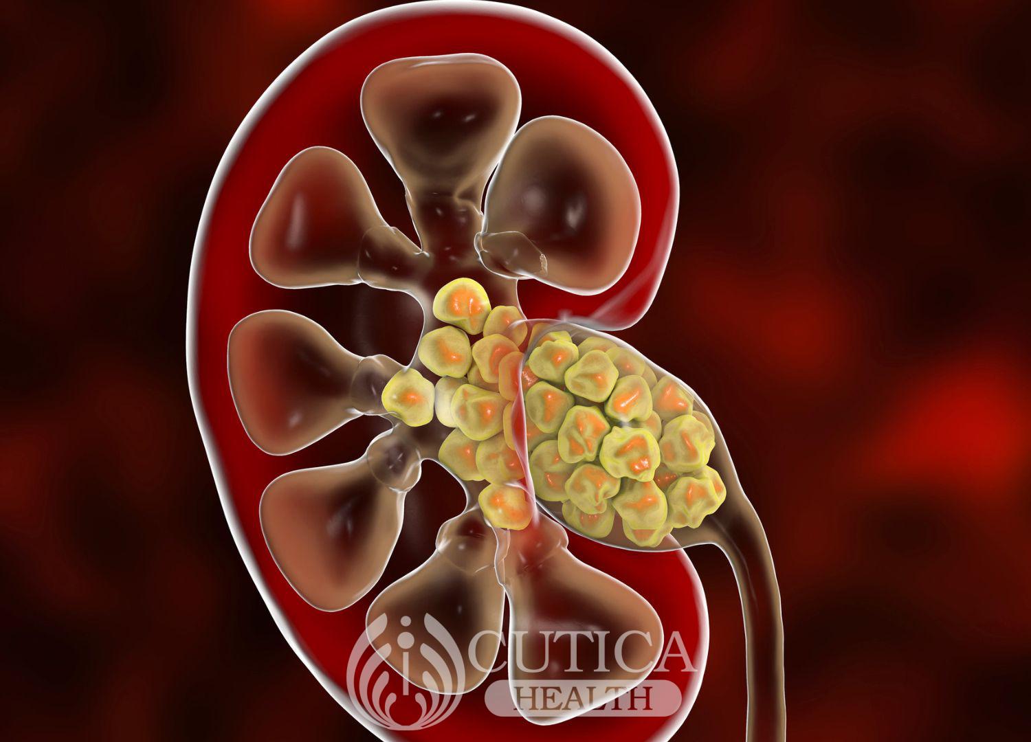 Urinary tract obstruction