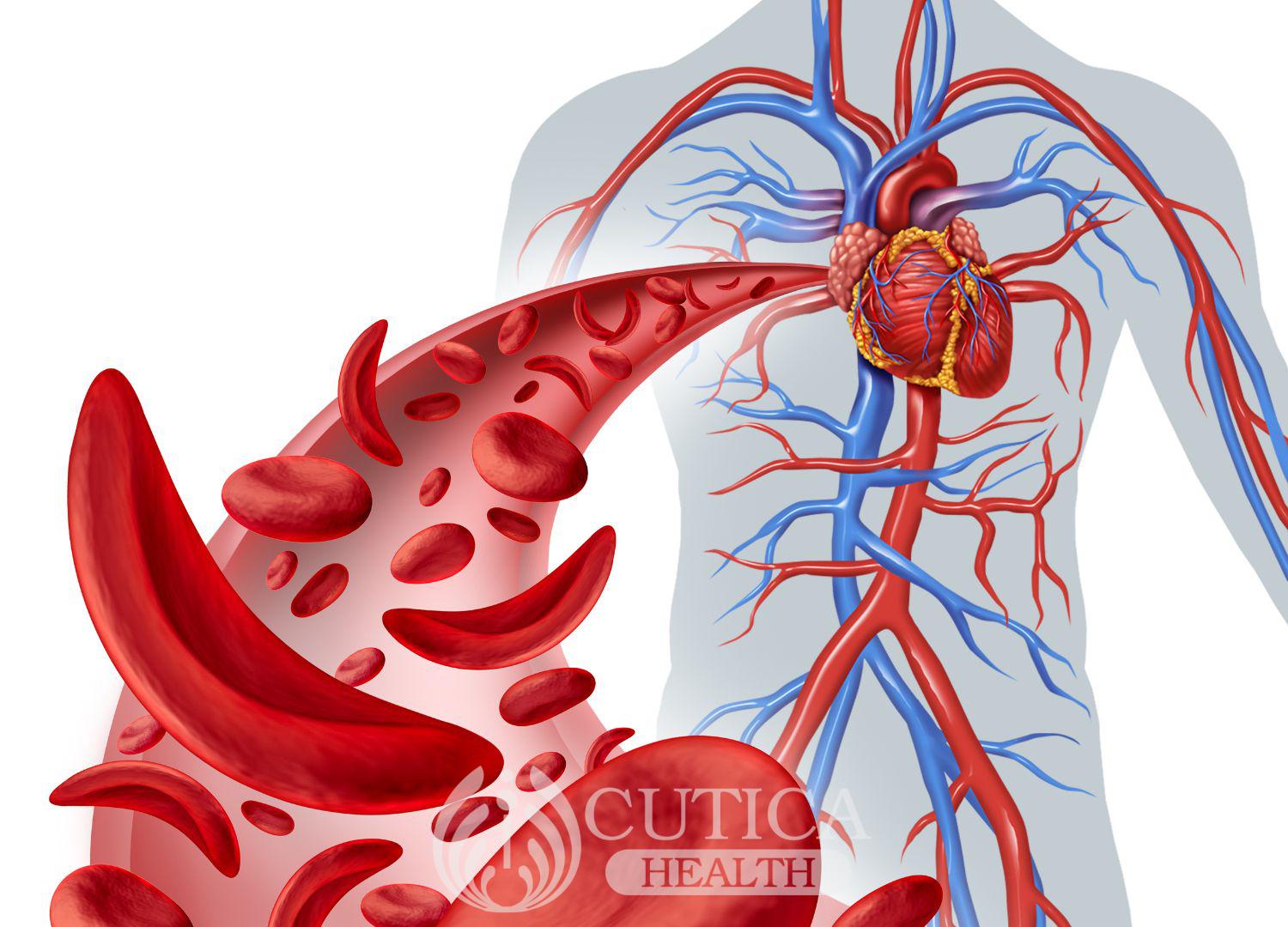 Anemia: Causes and Treatment (Pidgin)