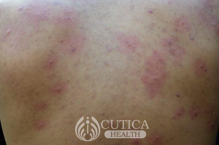 asian-teen-boy-inflammatory-acne-on-the-back_t20_mLKevn-1-768x509