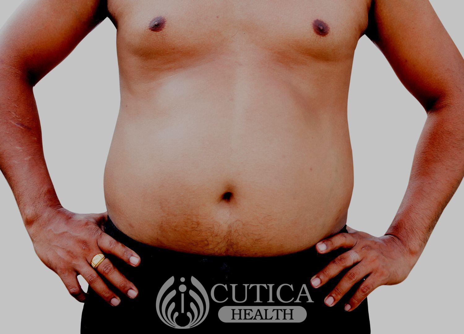 Gynecomastia: The Breasted Man
